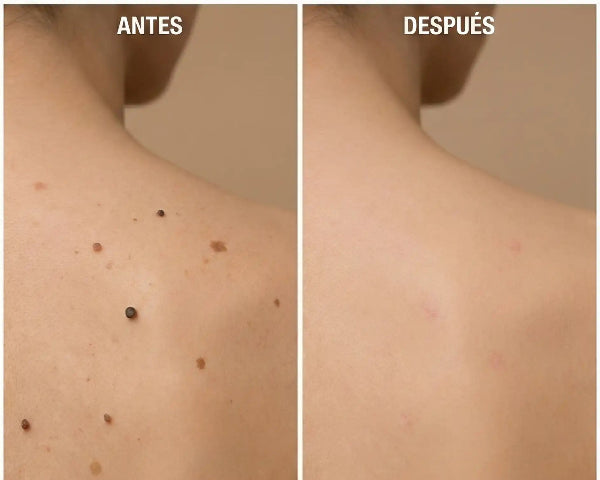 🔝LUMINIIX → ELIMINADOR DE VERRUGAS